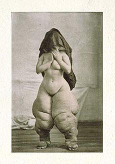 Penyakit Kaki Gajah