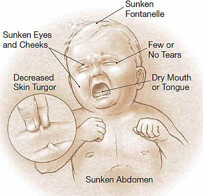 Tanda-tanda dehidrasi berbahaya.
