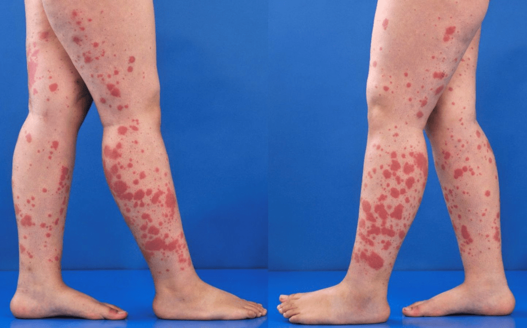 henoch-schönlein purpura