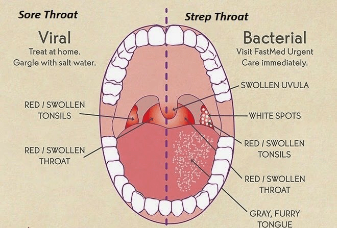 faringitis viral vs bakterial