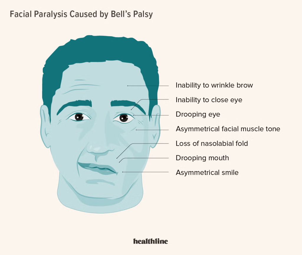 Bell's Palsy