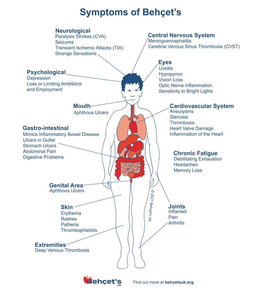 Gejala Penyakit Behçet 