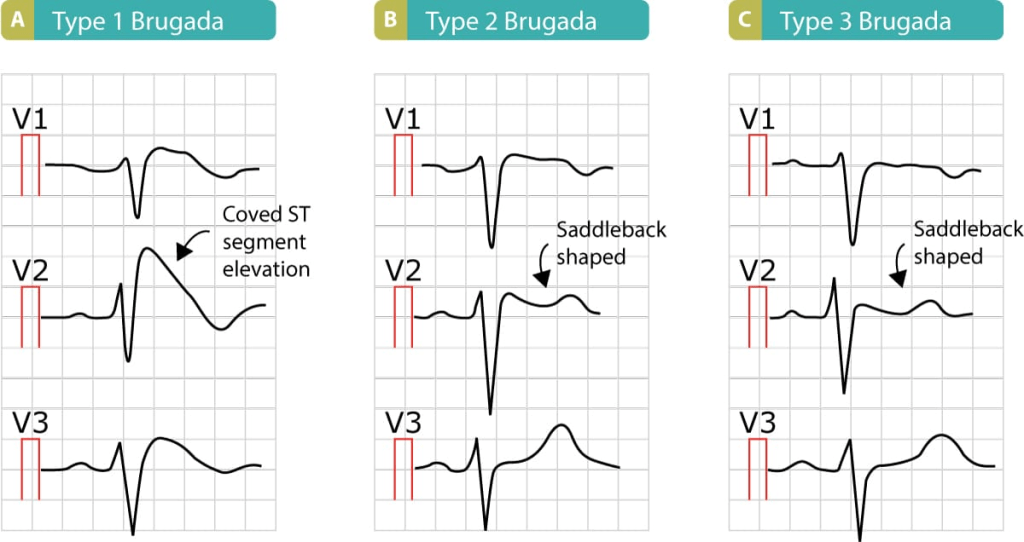 EKG Brugada